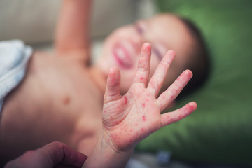 Boy with symptoms hand, foot and mouth disease - obrazy, fototapety, plakaty