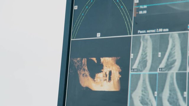 Dentist working on the computer. implant model. Dentist - Orthodontist. Close-up of 3D-model of the jaw on the computer screen. Modern dentistry. Orthodontist makes the model of the implant.