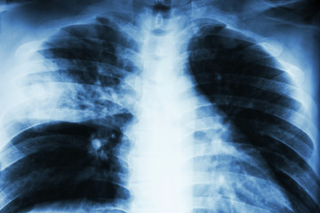 Lobar pneumonia . film chest x-ray show alveolar infiltration at right middle lobe due to...