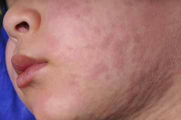 Urticaria on Face Close up - obrazy, fototapety, plakaty