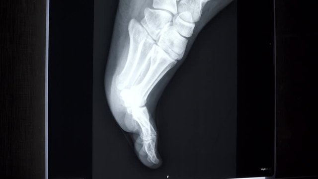 X-ray on illuminator panel - Foot Tilt