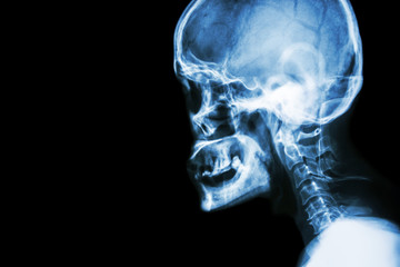 Film x-ray Skull lateral view  show normal human's skull and cervical spine and blank area at left...