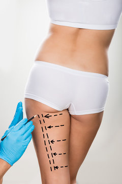 Surgeon Drawing Correction Lines On Woman's Thigh