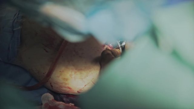 The surgeon is working on the establishment of prosthetic hip