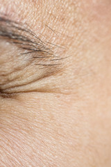 Wrinkles under the eyes