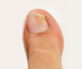 Fototapeta premium fungal nail infection