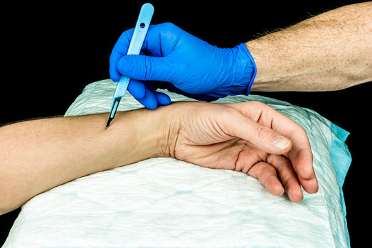 Hand with blue medical glove holding a scalpel to make an incision on an arm. Close up with black background. 