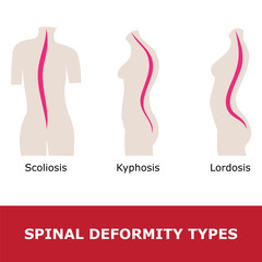 scoliosis, lordosis and kyphosis. vector illustration of spinal deformity types.