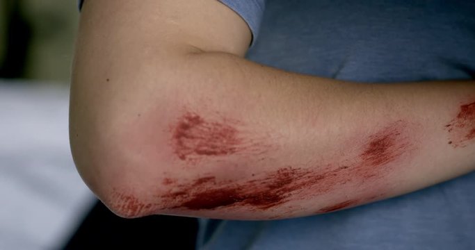 Male nurse's hands gently check young woman's injured arm for internal injuries in hospital casualty department.  Detail shot, recorded on fluid head tripod