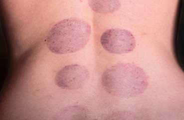Fototapeta premium Cupping therapy on hirudo medicinalis human body