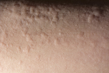 urticaria or allergy rash