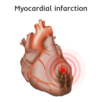 Myocardial infarction. Heart attack, pain. Damaged heart muscle. Anatomy illustration. Red image, white background.