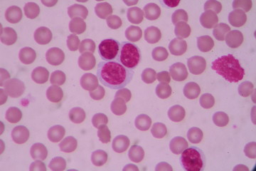 Blood smear shows large number of cancer leukemia cells(Blast cells)