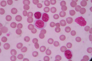 Blood smear shows large number of cancer leukemia cells(Blast cells)
