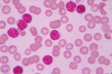 Blood smear shows large number of cancer leukemia cells(Blast cells)
