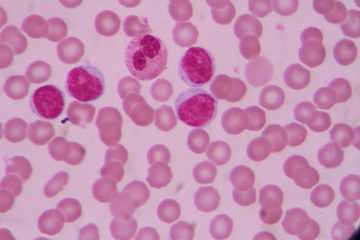Blood smear shows large number of cancer leukemia cells(Blast cells)
