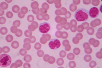Blood smear shows large number of cancer leukemia cells(Blast cells)