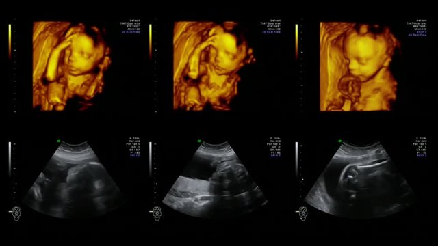 Digital image interpolation of newborn baby like 3D ultrasound of baby in mother's womb