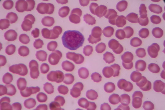 Atypical lymphocyte on blood smear