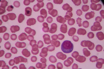 Atypical lymphocyte on blood smear