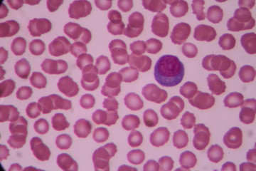 Atypical lymphocyte on blood smear