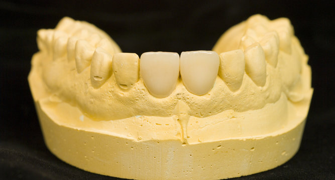 Calco denti