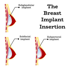 Plastic surgery of silicone breast implant,vector illustration.Female chest anatomy structure - medical wallpaper manual for implantaion,implant insertion or breast augmentation surgery