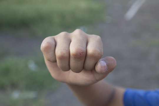 injuried finger