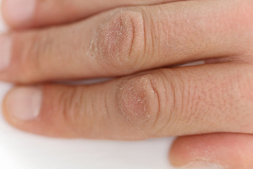 Male hands close up, happed skin, winter skin care concept