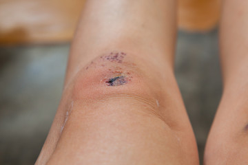 Scratch on the knee caused by a fall.