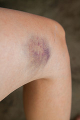 Fototapeta premium Scratch on the knee caused by a fall.