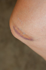 Scratch on the knee caused by a fall.