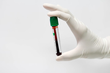 Test tube with blood plasma ready for testing..