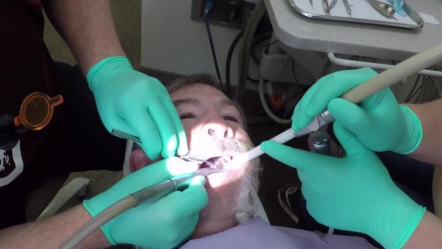 Dentist male patient drill decay cavity from tooth.Dental caries or tooth decay, breakdown of teeth due to bacteria. Pain and difficulty with eating.