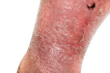 Psoriasis skin.