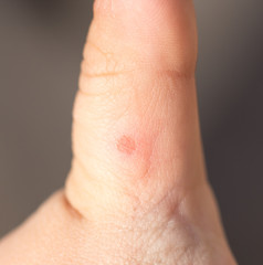 wound on his finger. macro
