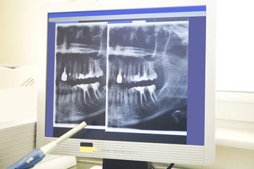 Xrays of dental work on teeth