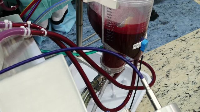 Cardiac surgeons performing a cardiac surgery. Surgeon's assistant removing healthy blood vessel from the leg in the foreground