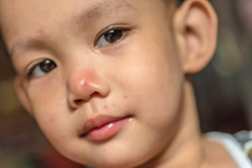   face of Asian baby boy who having hand foot mouth disease