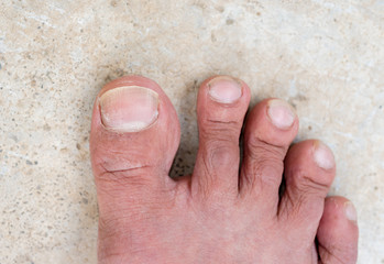 closeup nails having fungus