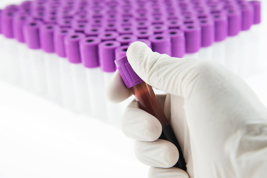 EDTA blood tube for CBC test in laboratory