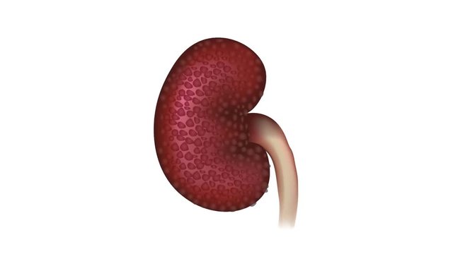 Diabetic Nephropathy, kidney disease caused by Diabetes. Healthy kidney changes to unhealthy 