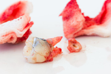Extraction of decayed tooth with bloody gauze pad on white background