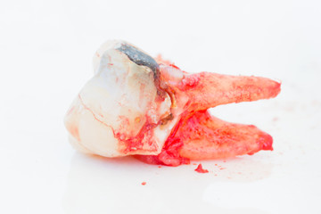 Extraction of decayed tooth on white background.