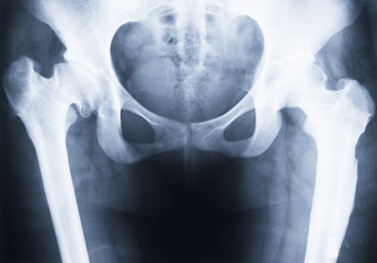 X-ray of deformed hip