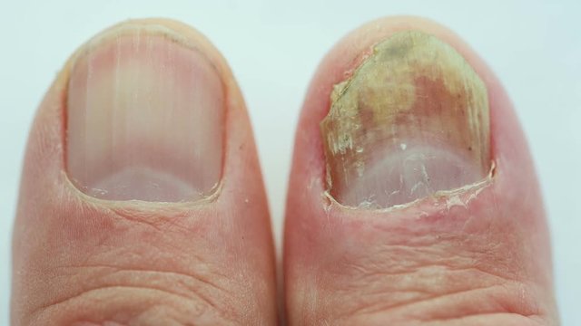 Fungus on the nail