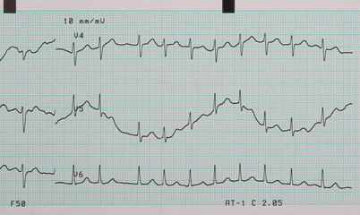 EKG arrhythmia absoluta, printout background