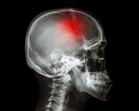 Stroke . film x-ray skull lateral view show human skull and stroke . cerebrovascular accident . isolated background