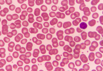 Normal red blood cells