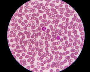 Blood smear shows rouleaux formation and white blood cell